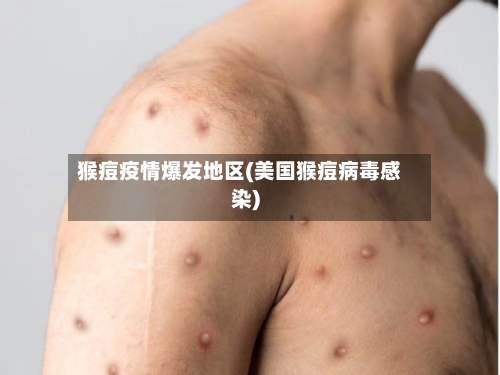 猴痘疫情爆发地区(美国猴痘病毒感染)-第2张图片